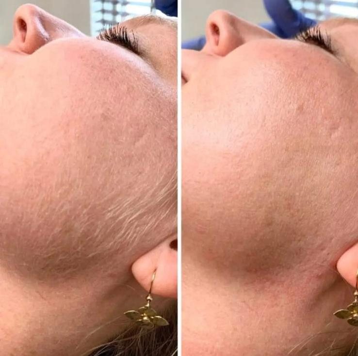 Ten înainte și după tratament facial